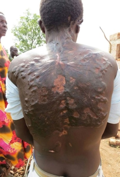 После разряда — что происходит с человеком, в которого ударила молния