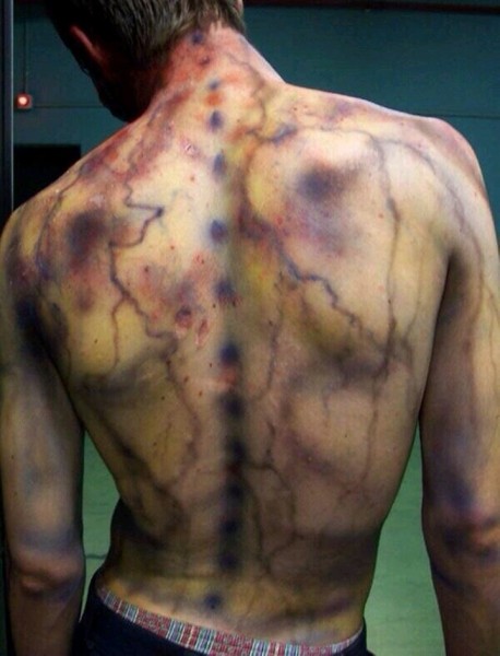 После разряда — что происходит с человеком, в которого ударила молния