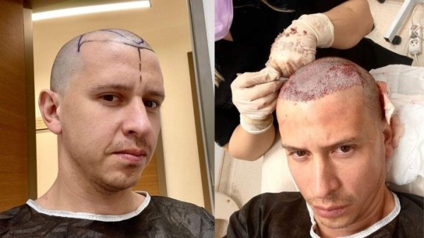 «Потратил 2 тысячи долларов – было весело». Белорус рассказал о трансплантации волос в Турции