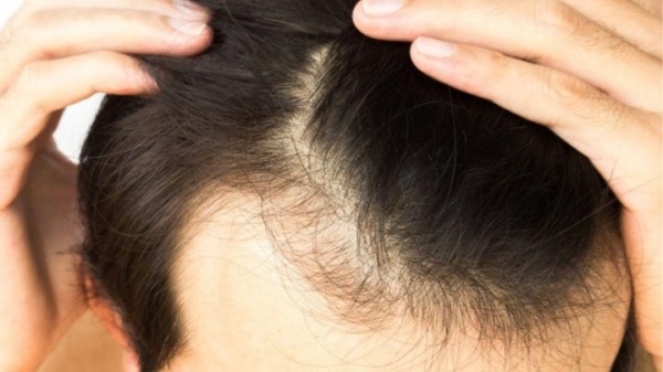 «Потратил 2 тысячи долларов – было весело». Белорус рассказал о трансплантации волос в Турции