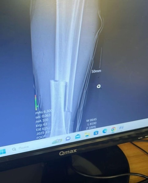 Вратарь сборной Беларуси по футболу получил страшную травму