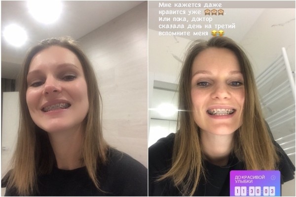 Потратил на зубы $15 тысяч — это того стоило? Белорусы, которые решились на брекеты во взрослом возрасте